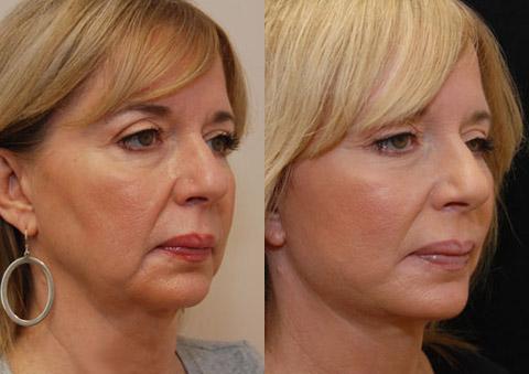 Minilift / Facelift Before and After Photos in Cincinnati, OH, Patient 5965