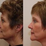 Minilift / Facelift Before and After Photos in Cincinnati, OH, Patient 5968