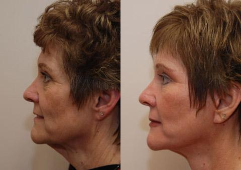 Minilift / Facelift Before and After Photos in Cincinnati, OH, Patient 5968