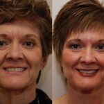 Minilift / Facelift Before and After Photos in Cincinnati, OH, Patient 5968