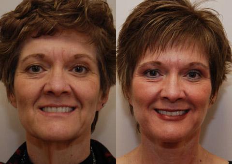 Minilift / Facelift Before and After Photos in Cincinnati, OH, Patient 5968