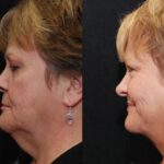 Minilift / Facelift Before and After Photos in Cincinnati, OH, Patient 5973
