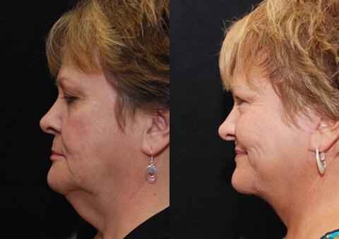 Minilift / Facelift Before and After Photos in Cincinnati, OH, Patient 5973