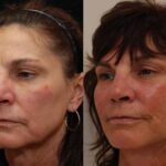 Minilift / Facelift Before and After Photos in Cincinnati, OH, Patient 5976