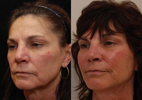 Minilift / Facelift Before and After Photos in Cincinnati, OH, Patient 5976