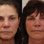 Minilift / Facelift Before and After Photos in Cincinnati, OH, Patient 5976