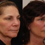 Minilift / Facelift Before and After Photos in Cincinnati, OH, Patient 5976