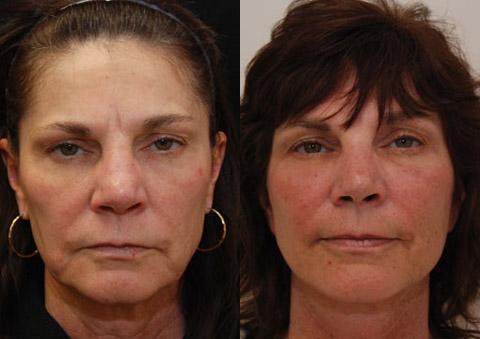 Minilift / Facelift Before and After Photos in Cincinnati, OH, Patient 5976