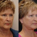 Minilift / Facelift Before and After Photos in Cincinnati, OH, Patient 5983