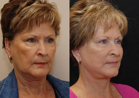 Minilift / Facelift Before and After Photos in Cincinnati, OH, Patient 5983