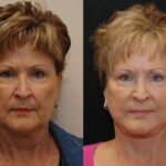 Minilift / Facelift Before and After Photos in Cincinnati, OH, Patient 5983