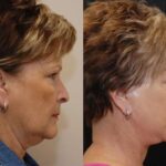 Minilift / Facelift Before and After Photos in Cincinnati, OH, Patient 5983