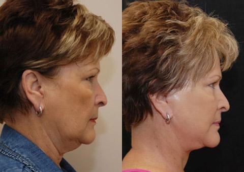 Minilift / Facelift Before and After Photos in Cincinnati, OH, Patient 5983