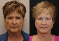 Minilift / Facelift Before and After Photos in Cincinnati, OH, Patient 5983