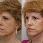 Minilift / Facelift Before and After Photos in Cincinnati, OH, Patient 5990