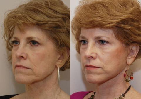 Minilift / Facelift Before and After Photos in Cincinnati, OH, Patient 5990