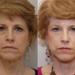 Minilift / Facelift Before and After Photos in Cincinnati, OH, Patient 5990