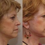 Minilift / Facelift Before and After Photos in Cincinnati, OH, Patient 5990