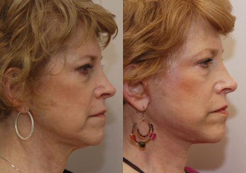 Minilift / Facelift Before and After Photos in Cincinnati, OH, Patient 5990