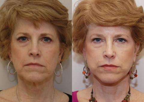 Minilift / Facelift Before and After Photos in Cincinnati, OH, Patient 5990