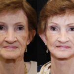 Minilift / Facelift Before and After Photos in Cincinnati, OH, Patient 5997