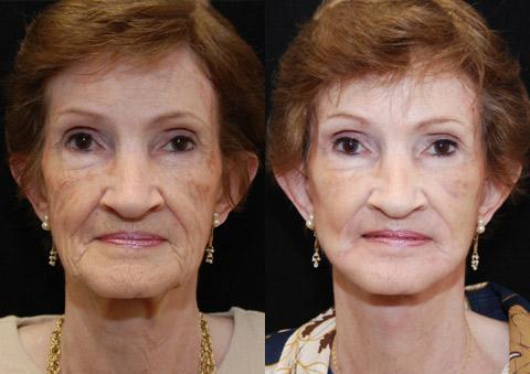 Minilift / Facelift Before and After Photos in Cincinnati, OH, Patient 5997