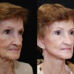 Minilift / Facelift Before and After Photos in Cincinnati, OH, Patient 5997