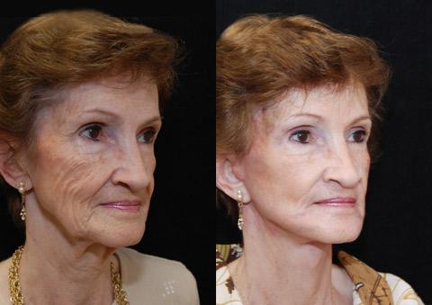 Minilift / Facelift Before and After Photos in Cincinnati, OH, Patient 5997