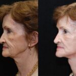 Minilift / Facelift Before and After Photos in Cincinnati, OH, Patient 5997
