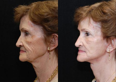 Minilift / Facelift Before and After Photos in Cincinnati, OH, Patient 5997
