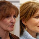 Minilift / Facelift Before and After Photos in Cincinnati, OH, Patient 6004