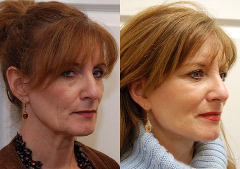 Minilift / Facelift Before and After Photos in Cincinnati, OH, Patient 6004