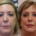 Minilift / Facelift Before and After Photos in Cincinnati, OH, Patient 6007