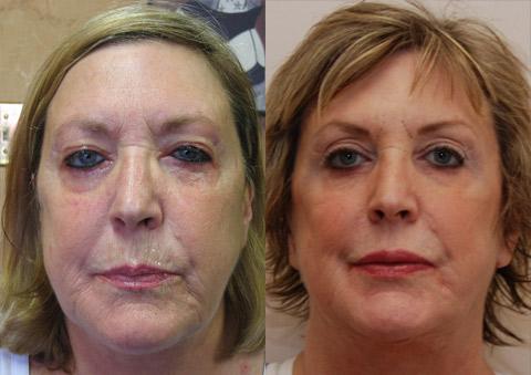 Minilift / Facelift Before and After Photos in Cincinnati, OH, Patient 6007