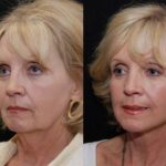 Minilift / Facelift Before and After Photos in Cincinnati, OH, Patient 6010
