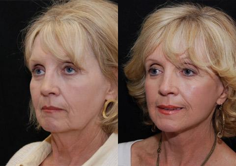 Minilift / Facelift Before and After Photos in Cincinnati, OH, Patient 6010