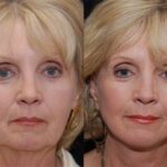 Minilift / Facelift Before and After Photos in Cincinnati, OH, Patient 6010
