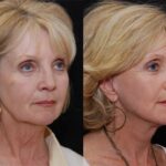 Minilift / Facelift Before and After Photos in Cincinnati, OH, Patient 6010
