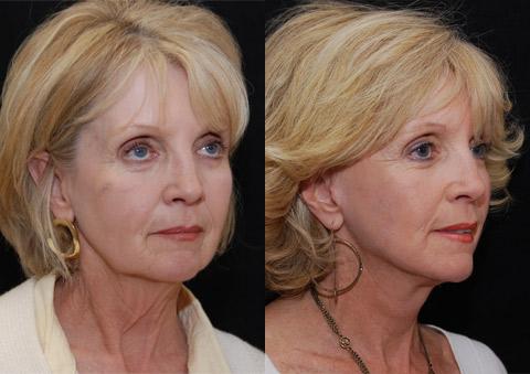 Minilift / Facelift Before and After Photos in Cincinnati, OH, Patient 6010