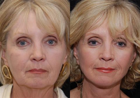 Minilift / Facelift Before and After Photos in Cincinnati, OH, Patient 6010