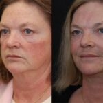 Minilift / Facelift Before and After Photos in Cincinnati, OH, Patient 6017