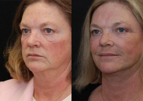 Minilift / Facelift Before and After Photos in Cincinnati, OH, Patient 6017