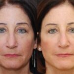 Minilift / Facelift Before and After Photos in Cincinnati, OH, Patient 6020