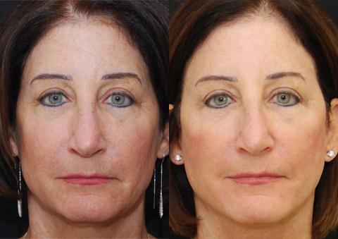 Minilift / Facelift Before and After Photos in Cincinnati, OH, Patient 6020