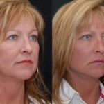 Minilift / Facelift Before and After Photos in Cincinnati, OH, Patient 6023