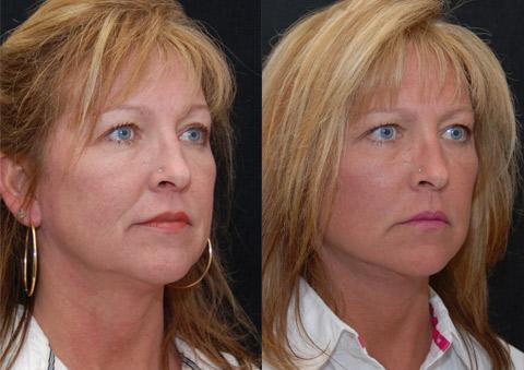 Minilift / Facelift Before and After Photos in Cincinnati, OH, Patient 6023