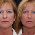 Minilift / Facelift Before and After Photos in Cincinnati, OH, Patient 6023