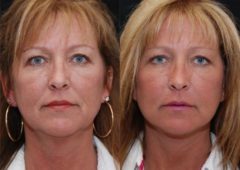 Minilift / Facelift Before and After Photos in Cincinnati, OH, Patient 6023