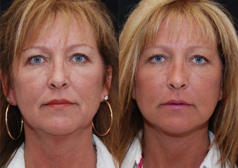 Minilift / Facelift Before and After Photos in Cincinnati, OH, Patient 6023