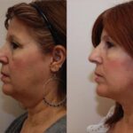 Minilift / Facelift Before and After Photos in Cincinnati, OH, Patient 6028